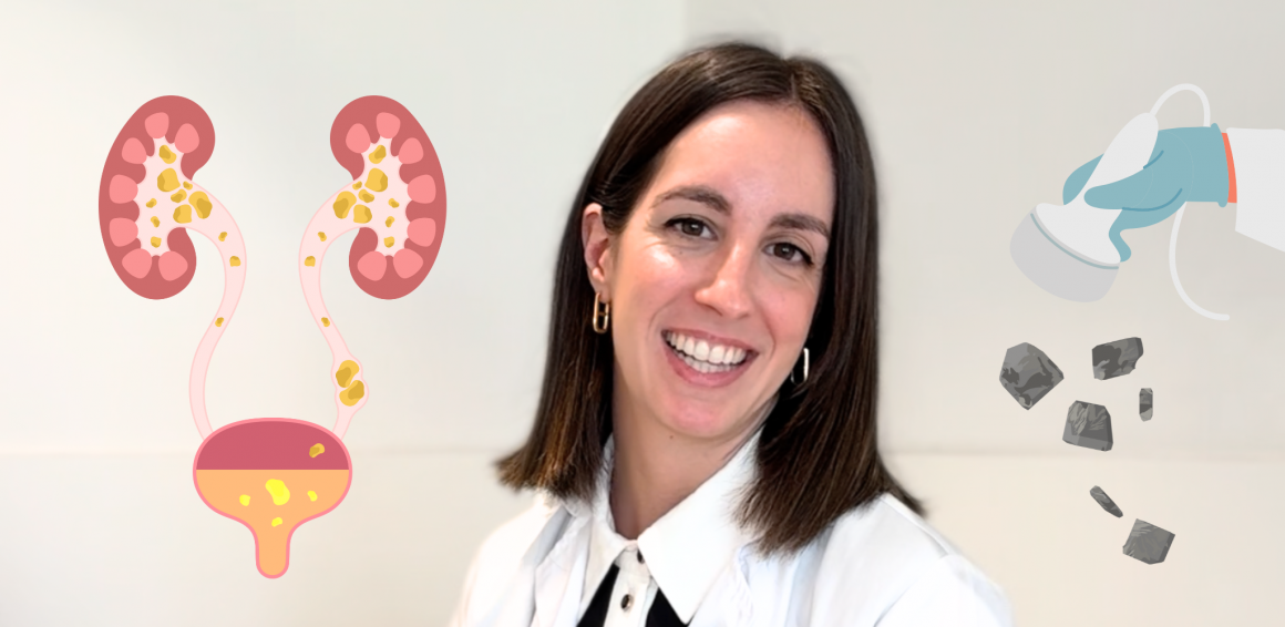 Dra. Sanz - Piedra en la vía urinaria Dra. Sanz con imagen de piedras en las vías urinarias